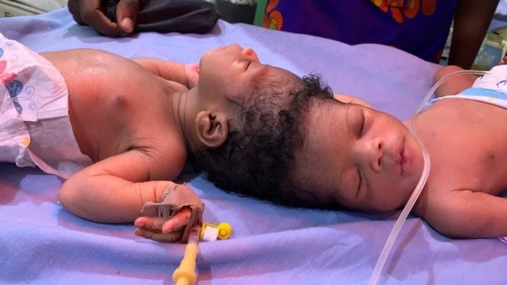 لە ئیمارات دووانەیەکی پێکەوەلکاو بە یارمەتیی ژیریی دەستکرد جیاکرانەوە