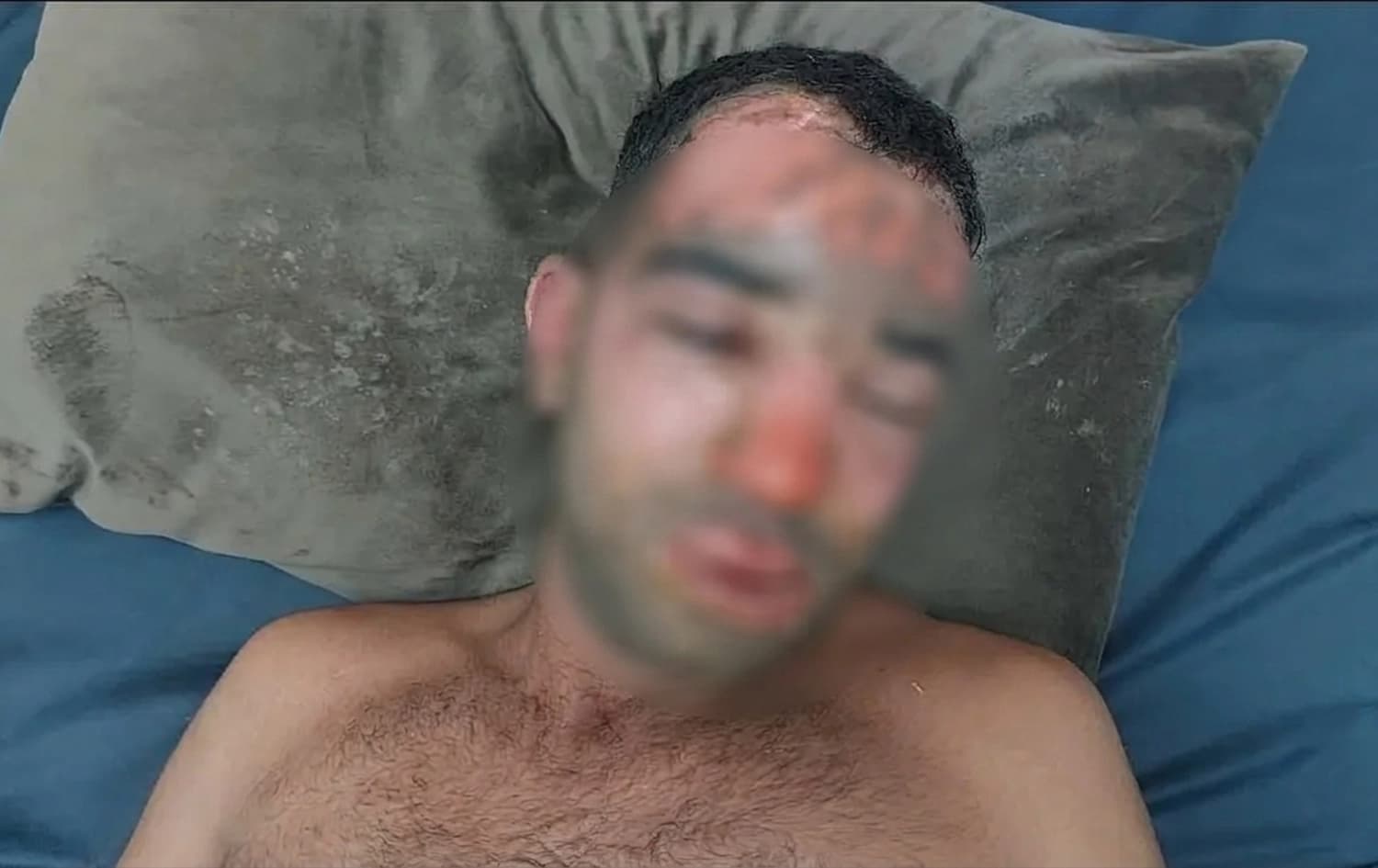 Pêşmeryekî ku di êrişê de rûyê wî şewitiye / Wêne: PAK