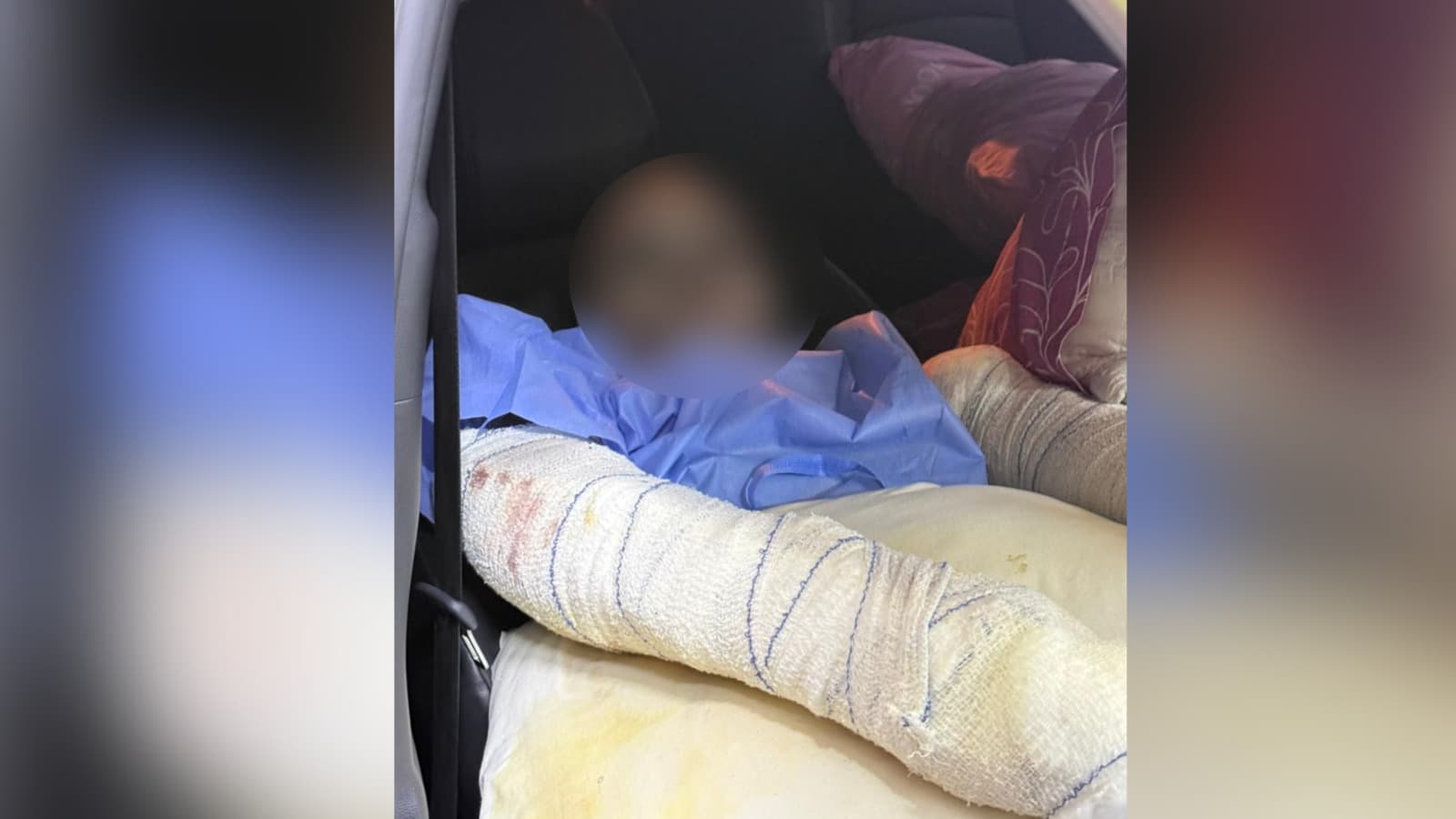 وێنە: ژنە بیانییەیەی جەستەی سووتاوە
